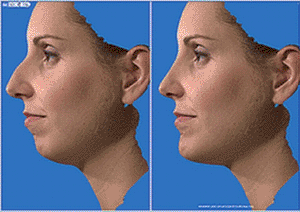 Image: Using virtual 3D modeling to create a 3D avatar for rhinoplasty (Photo courtesy of the Refine Institute). 